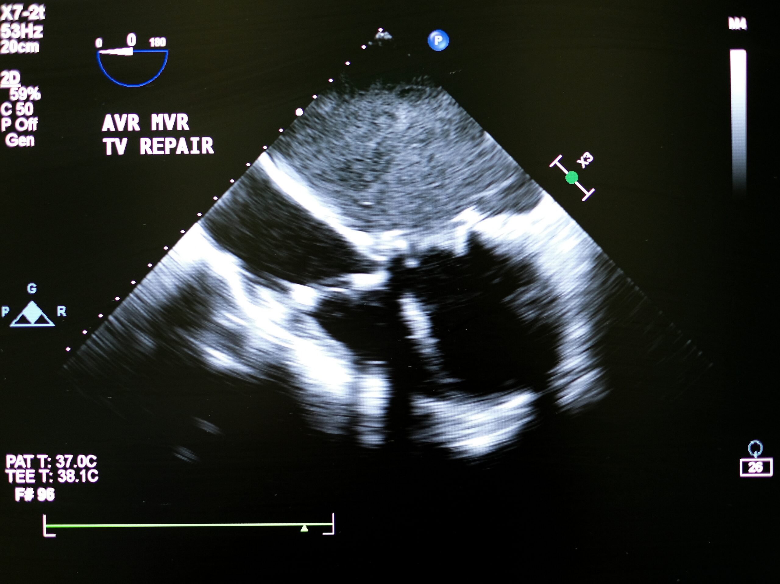 Echocardiogram,Showing,Spontaneous,Echocardiographic,Contrast,(sec),In,Left,Ventricle